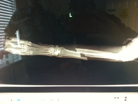 X-ray X-ray